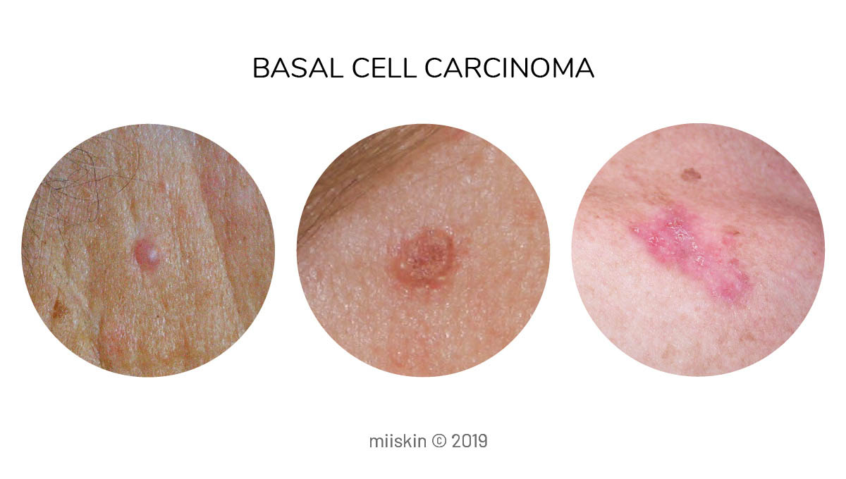 Basal Cell Skin Cancer Types