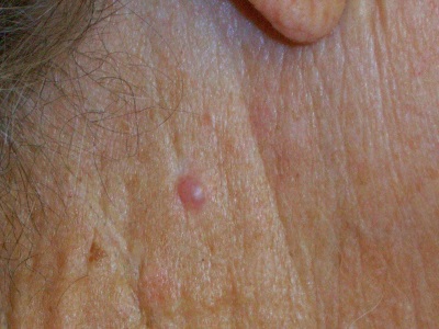 itchy spot skin cancer