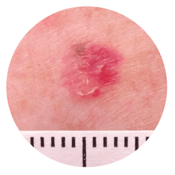 Skin Lesions abnormal changes