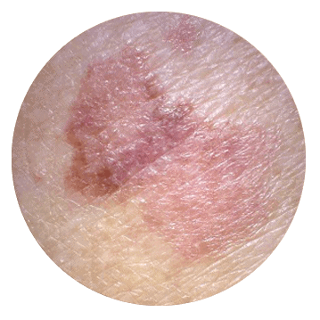 Melanoma Symptoms and Signs: Extensive Guide