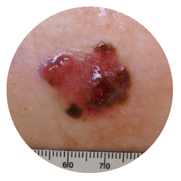 ABCDE diameter - Size of cancerous moles