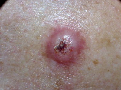 Mole and lump of skin that itches or bleeds
