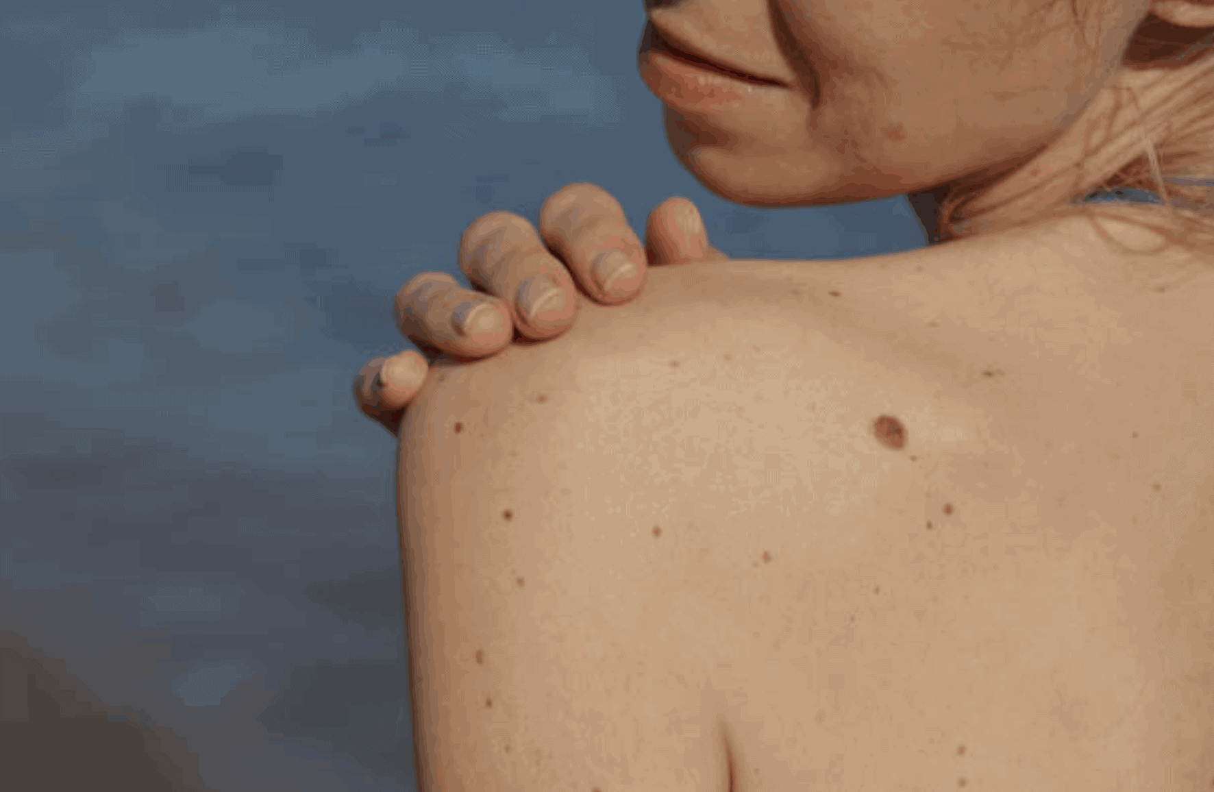 skin map - check your skin and moles guide on skin mapping