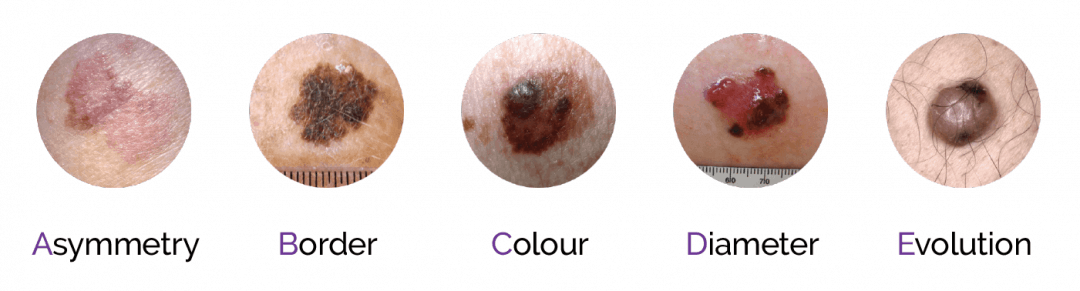 What Is Melanoma and What Does Melanoma Skin Cancer Look like?