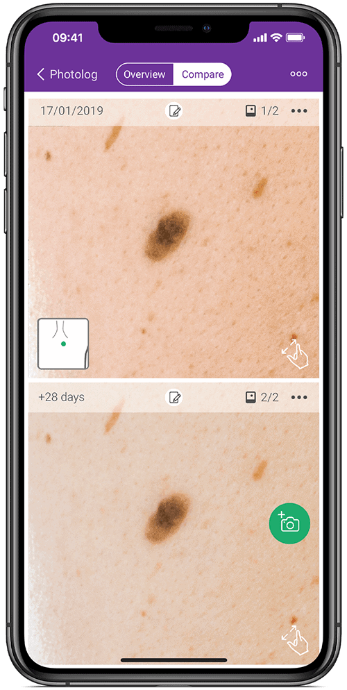 Compare mole images over time