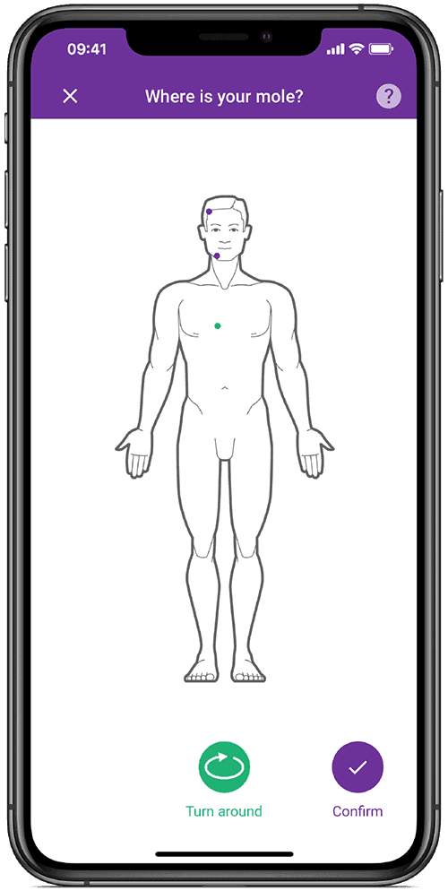 Check your moles with app