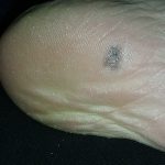 melanoma arising on the sole