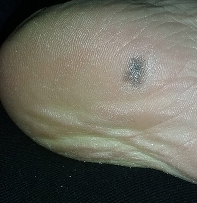 melanoma arising on the sole