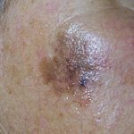 melanoma maligna