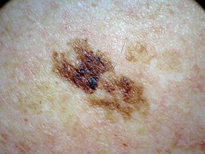 Melanoma Pictures | Skin Melanomas vs. Non-Cancerous Moles