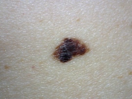 Nevus lentiginoso juntural atípico