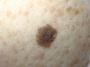 Melanoma Pictures | Skin Melanomas vs. Non-Cancerous Moles