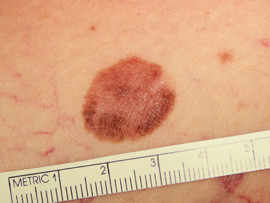 melanoma superficial foto