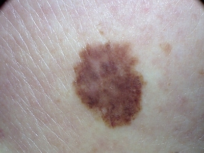 melanoma in situ
