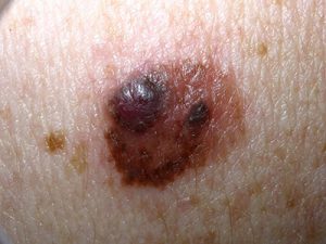 Melanoma Pictures | Skin Melanomas vs. Non-Cancerous Moles