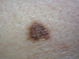 melanoma in situ forma e colore irregolari