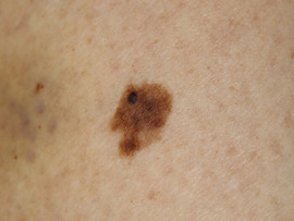 Melanoma superficial