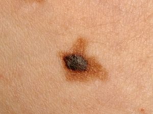 spreading melanoma