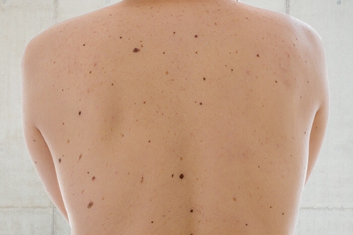 Many moles as risk factor