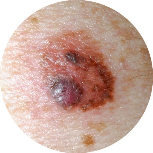 Skin Cancer - Types, Symptoms, Causes and Prevention