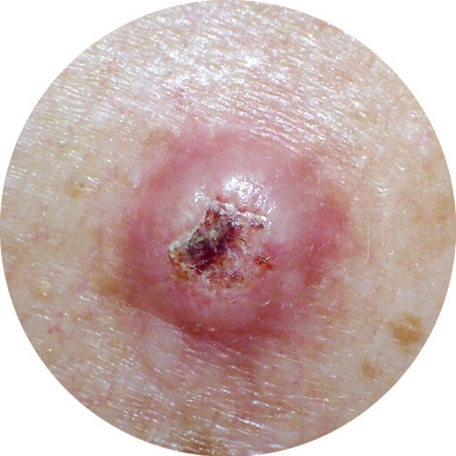 squamous cell skin carcinoma