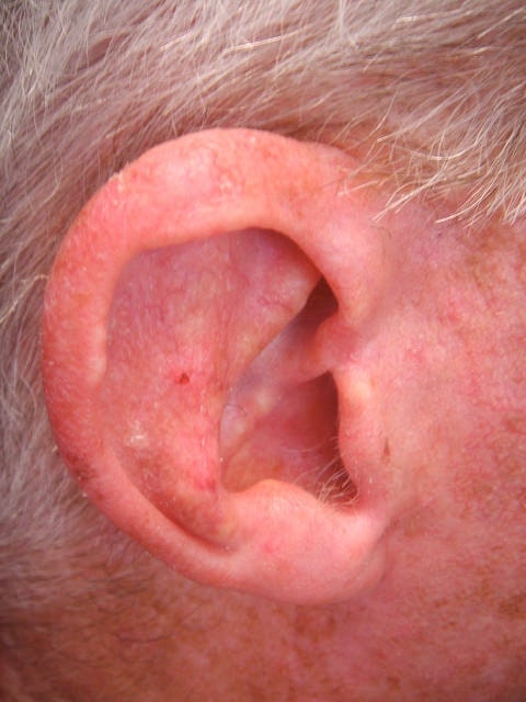 actinic keratosis skin cancer affecting the ear