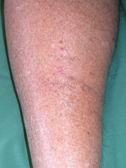 actinic keratosis skin cancer affecting the leg
