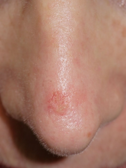 actinic keratosis skin cancer affecting the nose