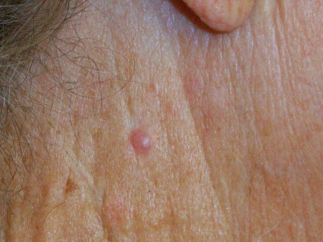 Basal Cell Carcinoma On Neck