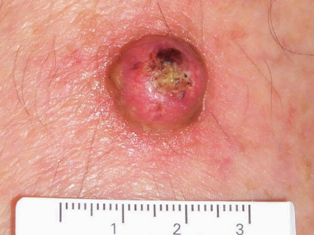 keratoacanthoma skin cancer