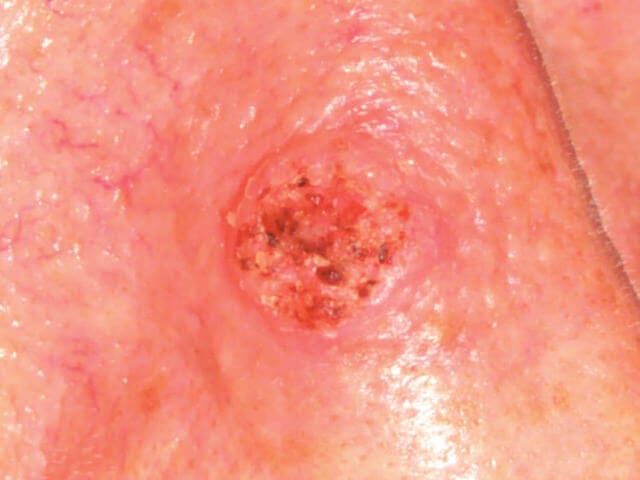 keratoacanthoma skin disease