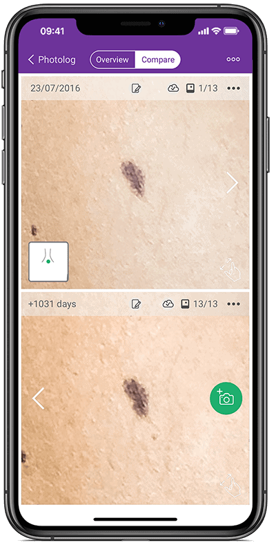 Compare mole images over time