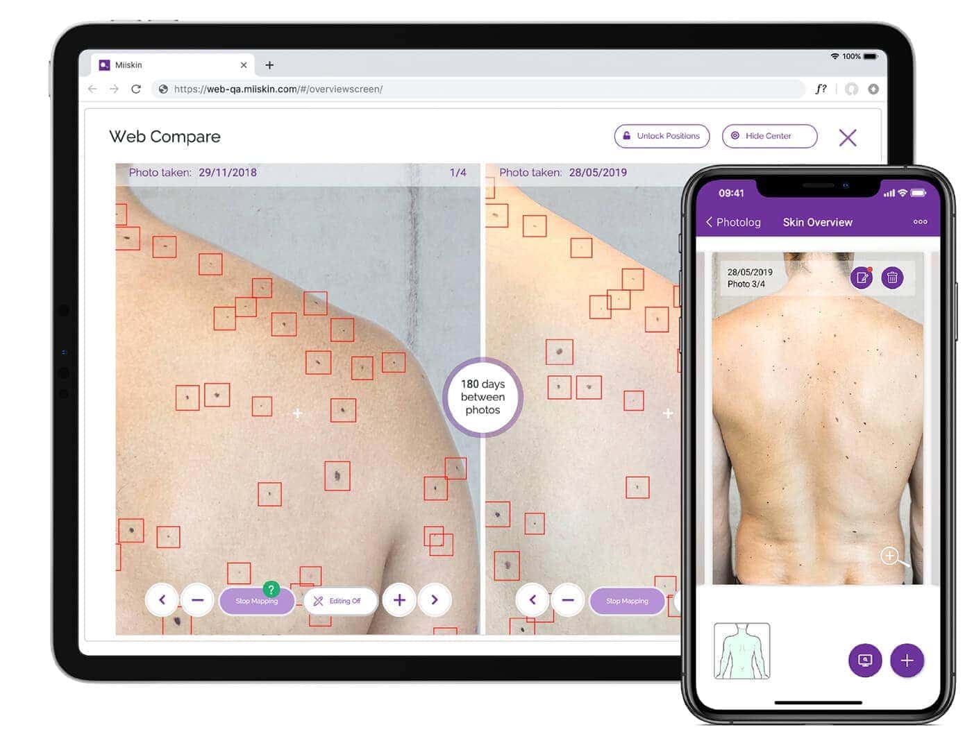 Most of the melanomas appear as the new marks on the skin Skin Mapping with Miiskin Premium