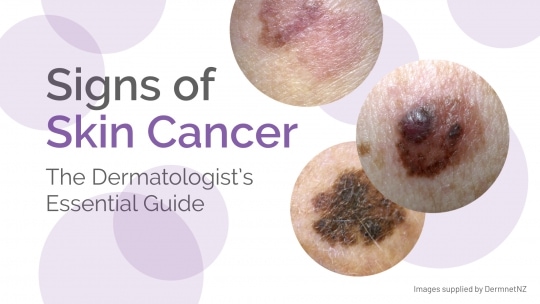 Signs of Skin Cancer – The Dermatologist’s Essential Guide 8