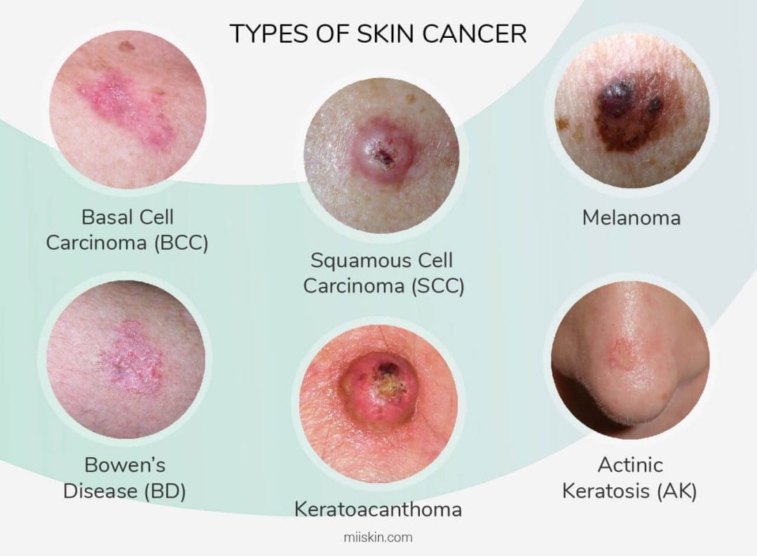 What Are The Different Types Of Skin Cancer Quizlet