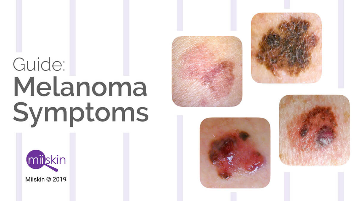 Melanoma Symptoms And Signs Extensive Guide