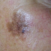 Lentigo maligna melanoma