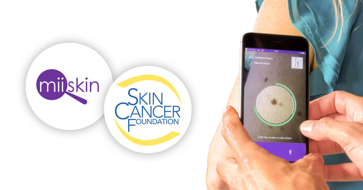 Miiskin Promotes Skin Cancer Early Detection
