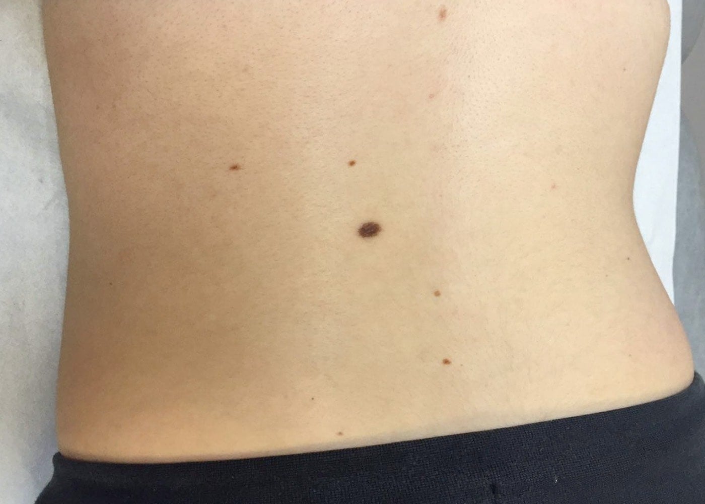 Joy's cancerous mole on her back Big mole on a back