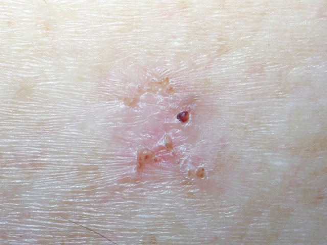 superficial basal cell carcinoma picture