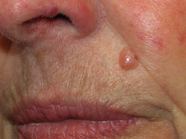 early basal cell carcinoma nose