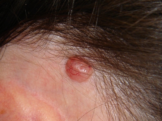 Basal Cell Carcinoma On Scalp Images