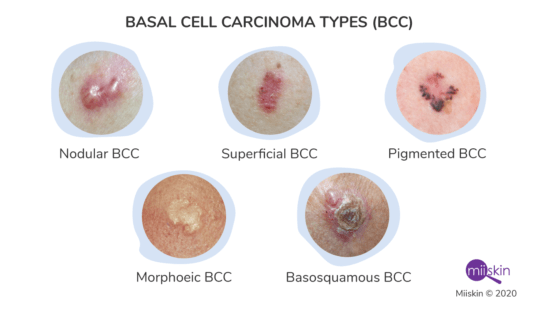 five basal cell cancer types pictures