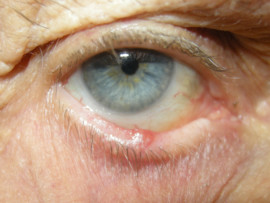 Basal Cell Carcinoma - Symptoms, Types and Pictures