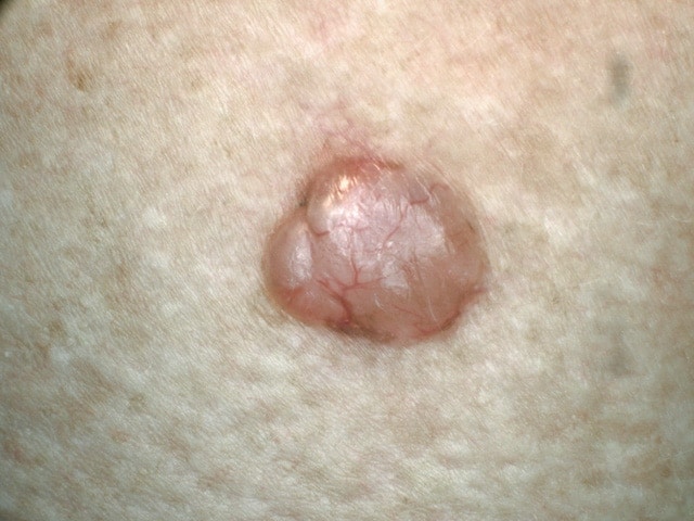 Basal Cell Carcinoma Symptoms Types And Pictures