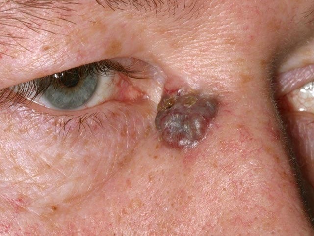 basal cell carcinoma pigmented type