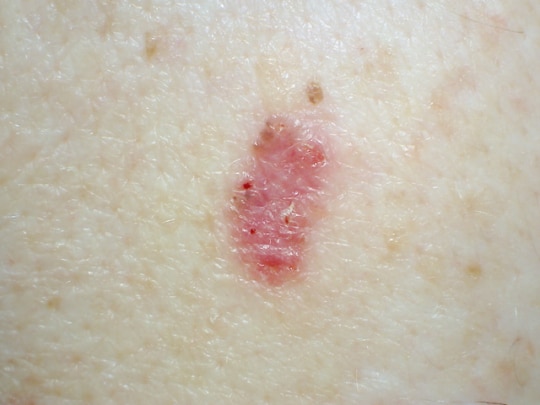 Basal Cell Carcinoma - Symptoms, Types and Pictures