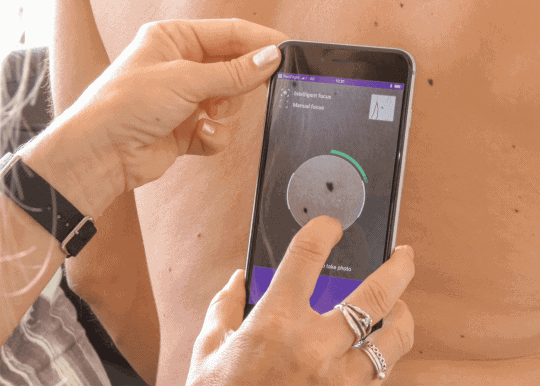 skin and mole checker app monitor your moles with miiskin app