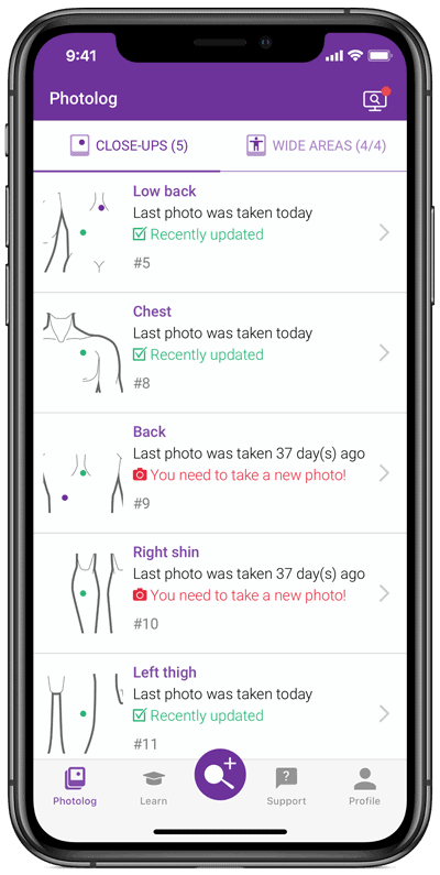 Set reminders to track moles Mole check alert