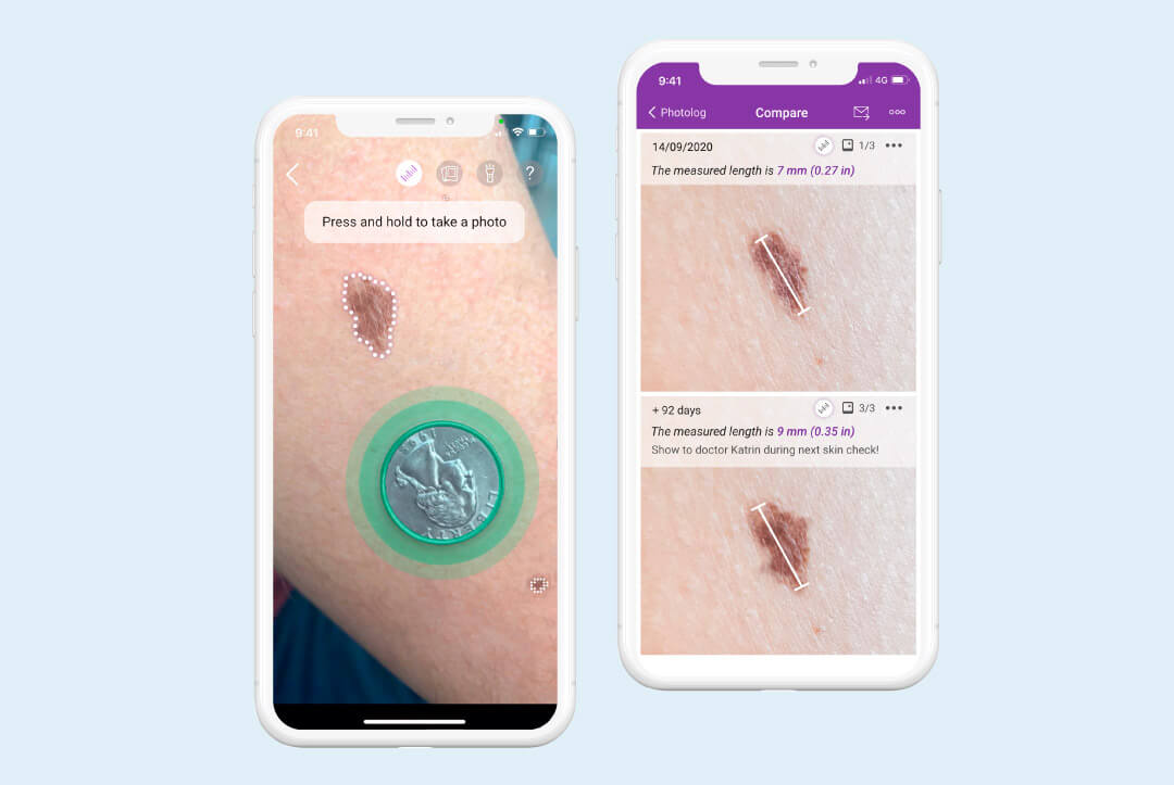 Miiskin App FAQs Mole Sizing